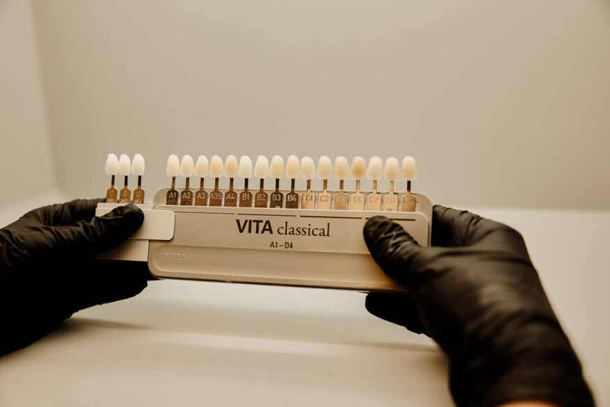 How to effectively capture shade when taking digital impressions