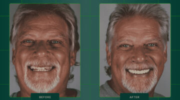Case Study: 10-Unit Zirconia Smile Transformation