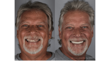 Case Study: 10-Unit Zirconia Smile Transformation